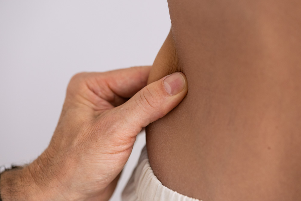 Arzt kneift für Fettabsaugung in die Hüften