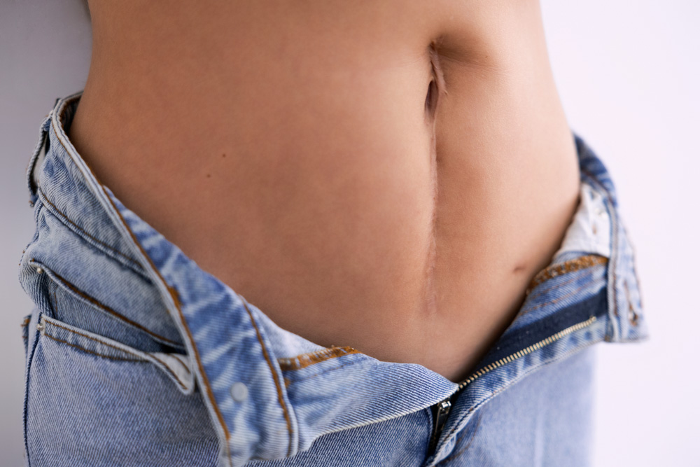 Narbe korrigieren naehe muenchen zentrum