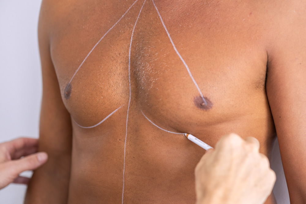 geschlechtsangleichende 1 brust operation muenchenjpg